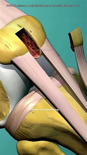 How a Torn ACL Is Rebuilt? (3D Animation)#tornaclsurgery #aclreconstruction #kneesurgery