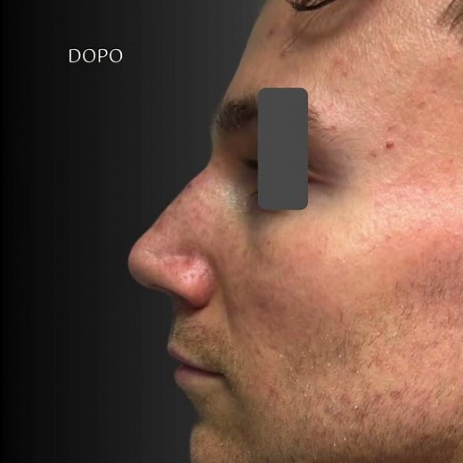 Rinoplastica Parziale Maschile #rinoplastica #rinoplasticaparziale