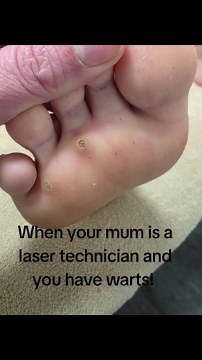 Effective Laser Ablation Treatment for Wart Removal