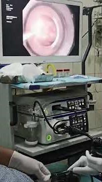 #EVL #endoscopic variceal ligation