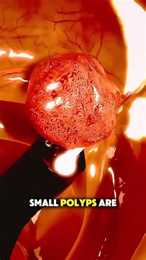 Colonpoly pectomy 3D Animation