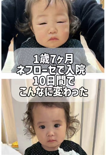 ネフローゼ症候群の回復体験談