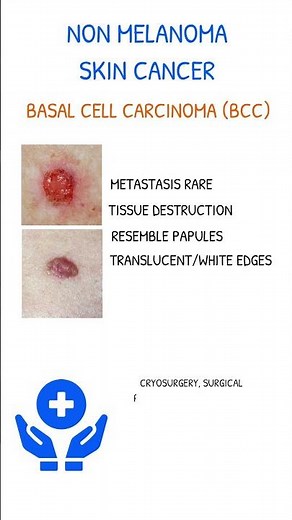 BASAL CELL CARCINOMA Symptoms & Treatment