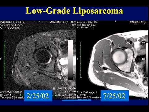 MRI of Soft Tissue Tumors | Pt.1