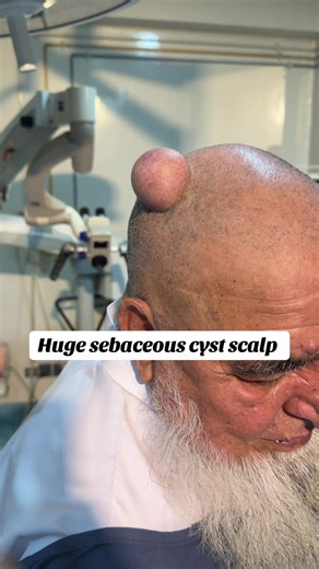 Sebaceous Cyst on Scalp: ZADA Thyroid Clinic Islamabad
