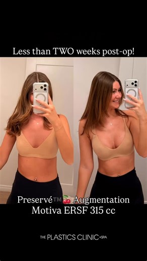 Jerry Chidester, MD on Instagram: "Preservé ™️🍒 Augmentation with Motiva ERSF 315 cc implants LESS than two weeks post-op! 🤩🤩 Our patient @bailey.ortiz is loving her early results from this amazing procedure Preservé™️! She flew in from out of state and less than two weeks ago underwent the surgery. She chose the 315 cc Full profile implants, and we were able to place them through a small 3 cm incision underneath her breast crease. It required NO incisions inside of her breast and no electroc
