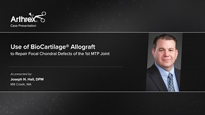 Use of BioCartilage® Allograft to Repair Focal Chondral Defects of the 1st MTP Joint