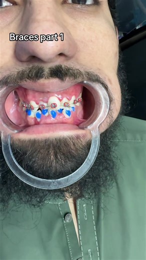 Understanding Braces Treatment: Part 1 Overview