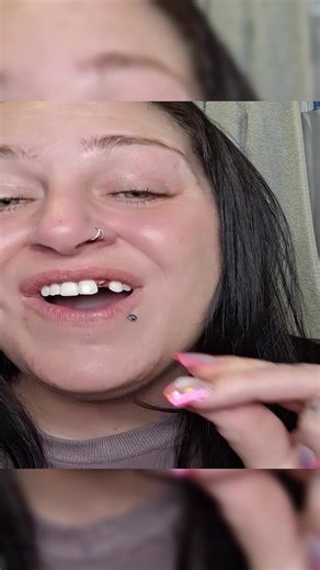 Quick Fix for Broken Tooth with Moldable Filling