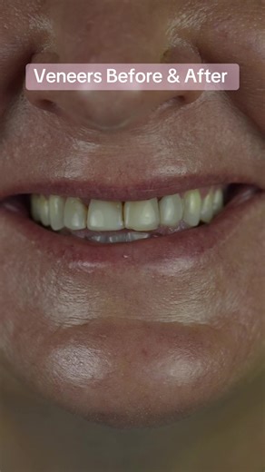 Veneers to correct old bonding, composite, and discoloration. #veneers #beforeandafter