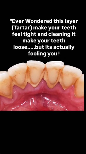 Dr Sandeep's Dental practice on Instagram: "“Does scaling make your teeth loose? Let’s bust this myth once and for all! 👇” Most people believe that professional cleaning or scaling weakens the teeth — but the truth is exactly the opposite. 🦠 Over time, a hard layer called tartar (calculus) forms around your teeth and gums. This layer gives a false feeling that teeth are tight and strong, but in reality, it’s slowly damaging your gums and bone — the actual support system of your teeth. When you