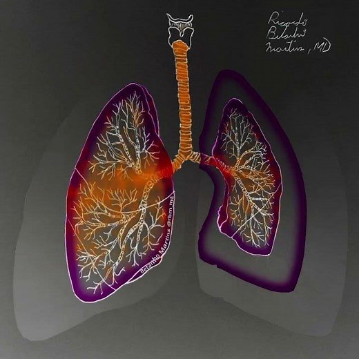 Pneumothorax Pathophysiology shown in 30 seconds
