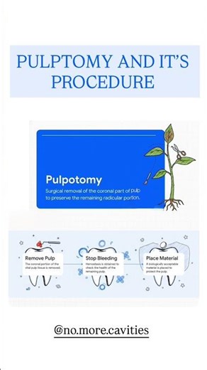 PULPOTOMY AND IT’S PROCEDURE #dentistry #endodontics #pulpotomy #inbde #dentaleducation