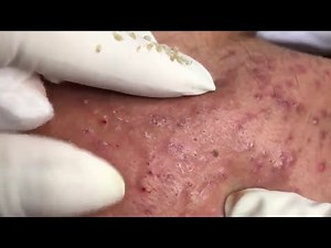 🔥 Pimple Popping 2020 NEW| Blackheads extraction| Blackheads removal| Acne removal|Acne treatment