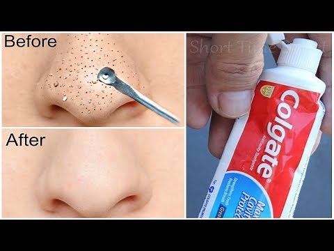 How to Clear Blackheads with Toothpaste