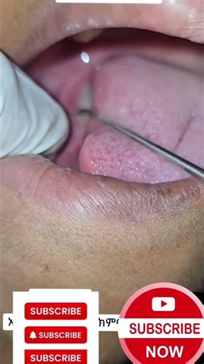 "Removal of Submandibular Stone – Quick Procedure Explained!" #short #salivaryglands