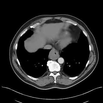 Esophageal leiomyoma distal esophagus - CT