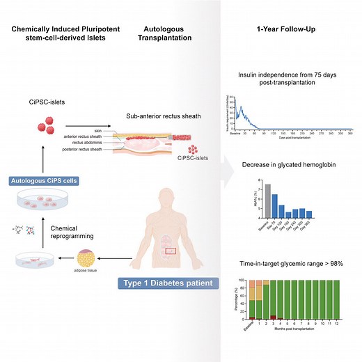 Stem cell therapy reverses type 1 diabetes in world first