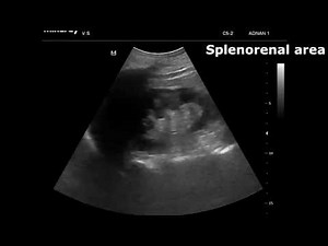 Bedside ultrasound in the differential diagnosis of peritonitis and gastrointestinal perforation