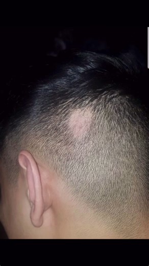 Overcoming Alopecia Areata: My Journey to Recovery