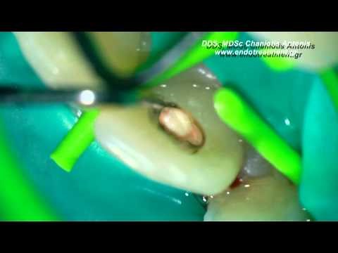 The concept of one step revascularization for the treatment of the partially necrotic immature roots
