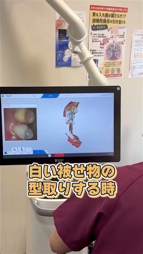 [Latest] Dental Impressions Now Covered by Insurance Using 3D Scanners!