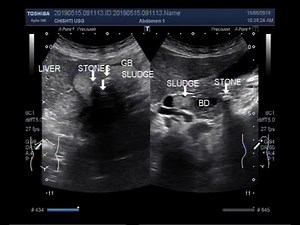 Ultrasound Video showing Gall bladder stones and sludge with Biliary stone and sludge.