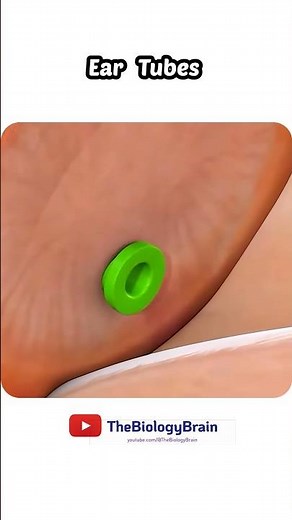 Tympanoplasty ( ear surgery 3d animation ) #earanatomy #3danimation