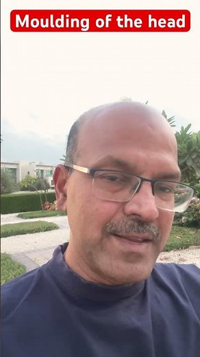 Moulding of the head l Newborn baby #moulding