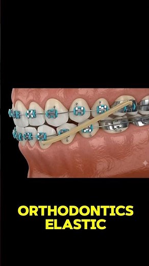 How Braces Rubber Bands ACTUALLY Work! 🤯 #braces #orthodontist