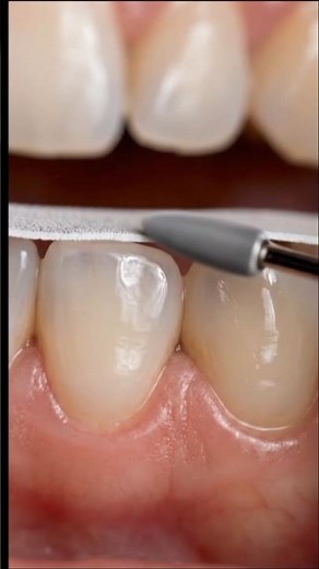 Hidden Between Teeth Silent Interproximal Decay Revealed Restored#Dental #HiddenCavity #ToothDecay