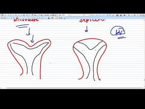 Difference between Bicornuate and Septate Uterus