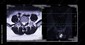 MRI L-S spine or lumbar spine Axial T2W view with sagittal plane for diagnosis spinal cord compression.