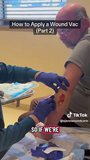 Before applying the Wound VAC, we 'window' the healthy skin around the wound using a thin layer of DuoDERM. This creates a barrier to protect the periwound edge trom the effects of negative pressure. It's all about clean technique and thoughtful prep. #WoundVAC #WoundCareBasics #InfectionPrevention #DuoDERM #NegativePressureTherapy