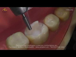 Incrustacion Onlay