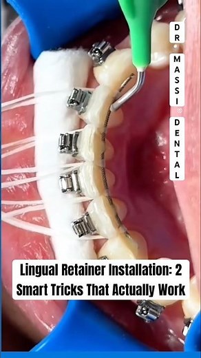 Lingual Retainer Installation: 2 Smart Tricks That Actually Work#BRACES