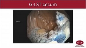 Douglas K. Rex, MD, MASGE and Amitabh Chak, MD, FASGE discuss Polypectomy Techniques: Granular Lateral Spreading Cecum in this video tip. See the full video online. http://ow.ly/B7si50BGRGS #ASGE #GITwitter #GIEndoscopy #GITwitter #gastroenterology #endoscopy | American Society for Gastrointestinal Endoscopy - ASGE