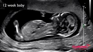 At 12 weeks, your baby is fully formed, right down to the teeny-tiny toes. This is your first chance to get a glimpse of your little one. Find out more about your 12 week scan here >>> http://ow.ly/GgVb30bAeEb | everymum.ie