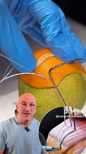 Understanding Rotator Cuff Tear Surgery Techniques