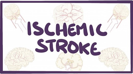 Ischemic stroke: Video, Causes, & Meaning | Osmosis