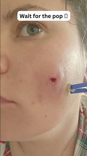 Large Blackheads Extraction Big Cystic Acne Blackheads&Whiteheads Removal Pimple Popping #1019 2026