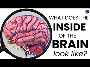 Endoscopic surgery for brain. Third ventricular colloid cyst. Inside the brain.