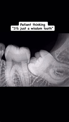 Mohindra dental hospital on Instagram: "“It’s just a wisdom tooth” 🦷 …until the pain starts.. An impacted wisdom tooth can cause: • Severe pain and cheek swelling • Damage to the tooth in front • Infection and pus formation • Difficulty in opening the mouth • Bigger surgery if treatment is delayed Don’t Ignore The Signs. Early check-up = easier treatment and less pain. #wisdomtooth #DentalCare #HealthySmile #DentistAdvice #OralHealth"