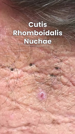 Cutis Rhomboidalis Nuchae: Sun Damage Blackheads