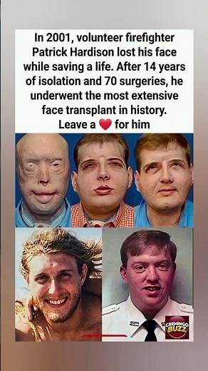 He lost his face saving a life and got the most extensive face transplant ever