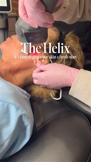 Renew Wellness and Aesthetics on Instagram: "Why everyone is loving the Helix and why it is quickly becoming a favorite service. ✨ The Helix laser delivers powerful skin resurfacing with smoother texture, brighter tone, and softer fine lines. It combines fractional CO₂ with non ablative technology so you get big results with less downtime. Clients love that it is customizable for gentle refreshes or deeper correction. If you want glowing, smoother, healthier looking skin this winter, the Helix i