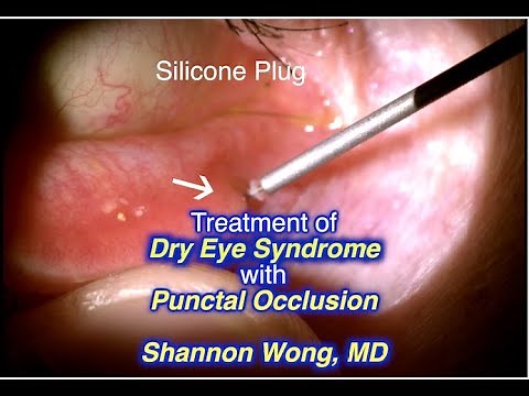 Punctal occlusion for treatment of Dry Eye. Shannon Wong, MD 11-17-19