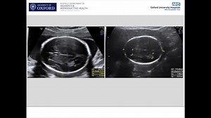 2.4K views · 53 reactions | AJOG Presents: The effect of maternal body mass index on fetal ultrasound image quality https://www.ajog.org/article/S0002-9378(21)00489-0/fulltext American College of Obstetricians and Gynecologists - ACOG International Society of Ultrasound in Obstetrics and Gynecology (ISUOG) Royal College of Obstetricians and Gynaecologists RCOG American Institute of Ultrasound in Medicine (AIUM) | American Journal of Obstetrics & Gynecology | Facebook