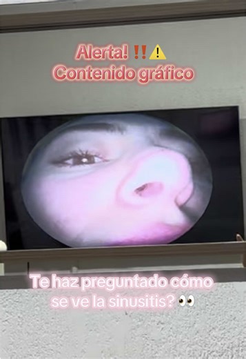 Sinusitis: ¿Cómo se ve y tratamiento en video?