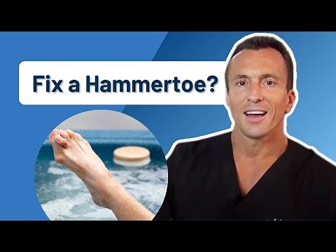 How Do You Fix a Hammertoe? | Ask Dr. Moore